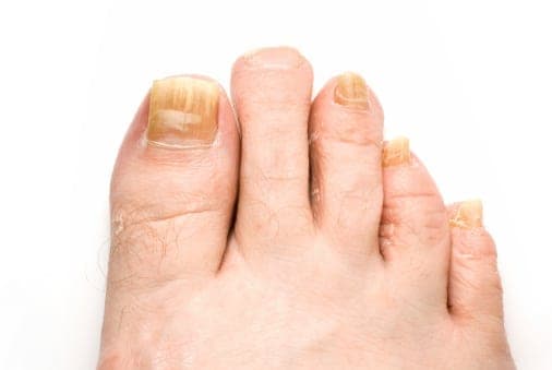 Toenail Fungal Infections | Water's Edge Dermatology