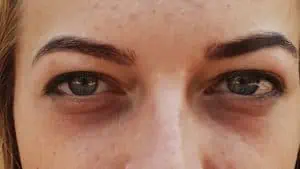 Veins Under Eyes: Causes & Treatment Options