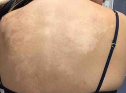 Tinea Versicolor Treatment, Water's Edge Dermatology