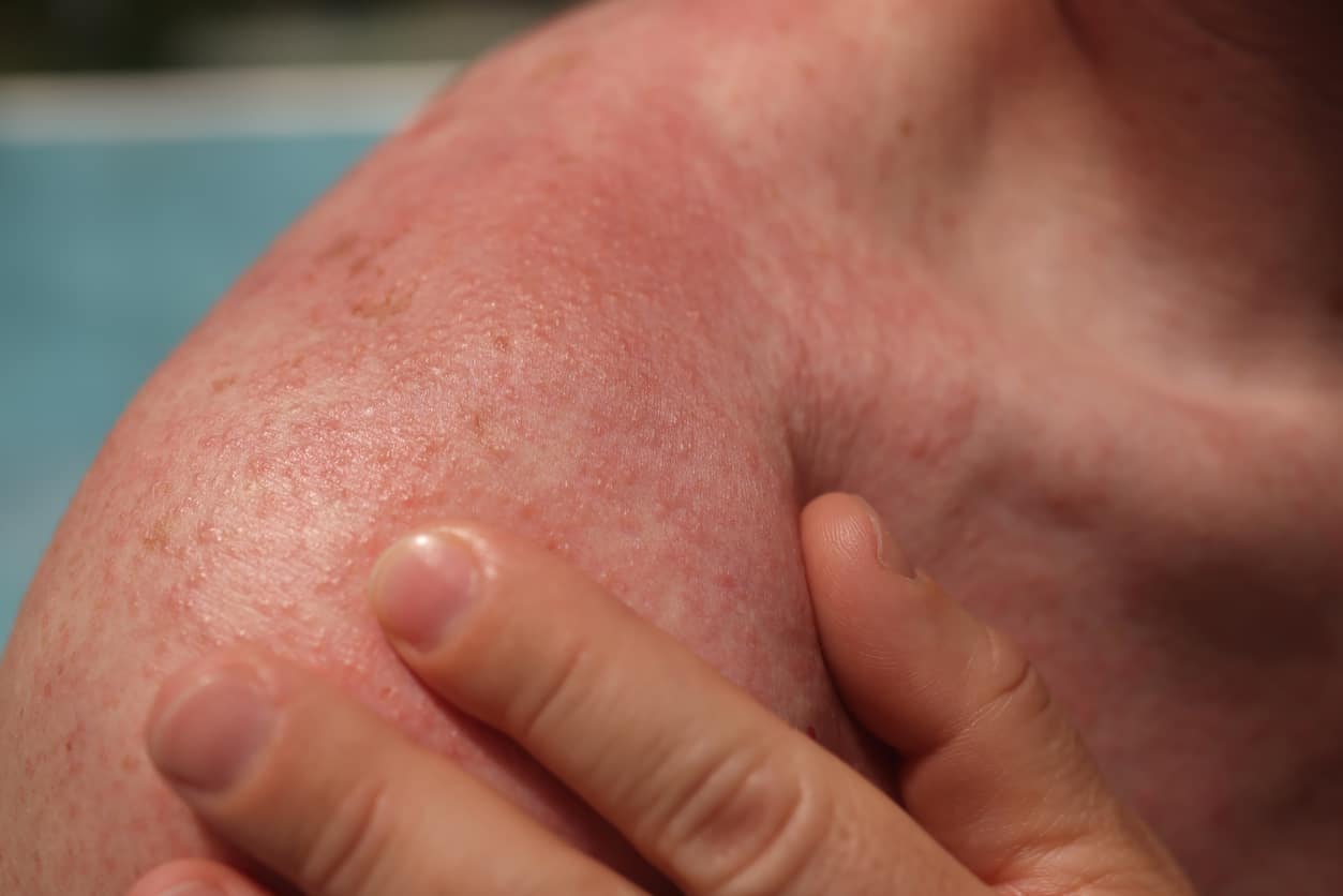 What's That Summer Skin Rash? - Water's Edge Dermatology