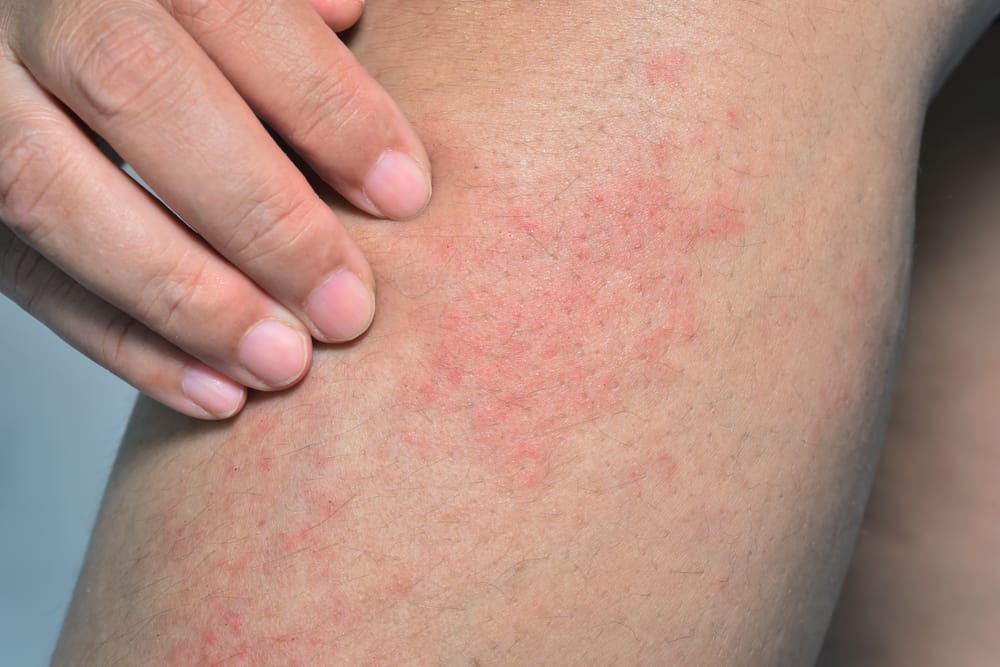 Swimmers Itch & Cercarial Dermatitis - Causes, Prevention, Treatment