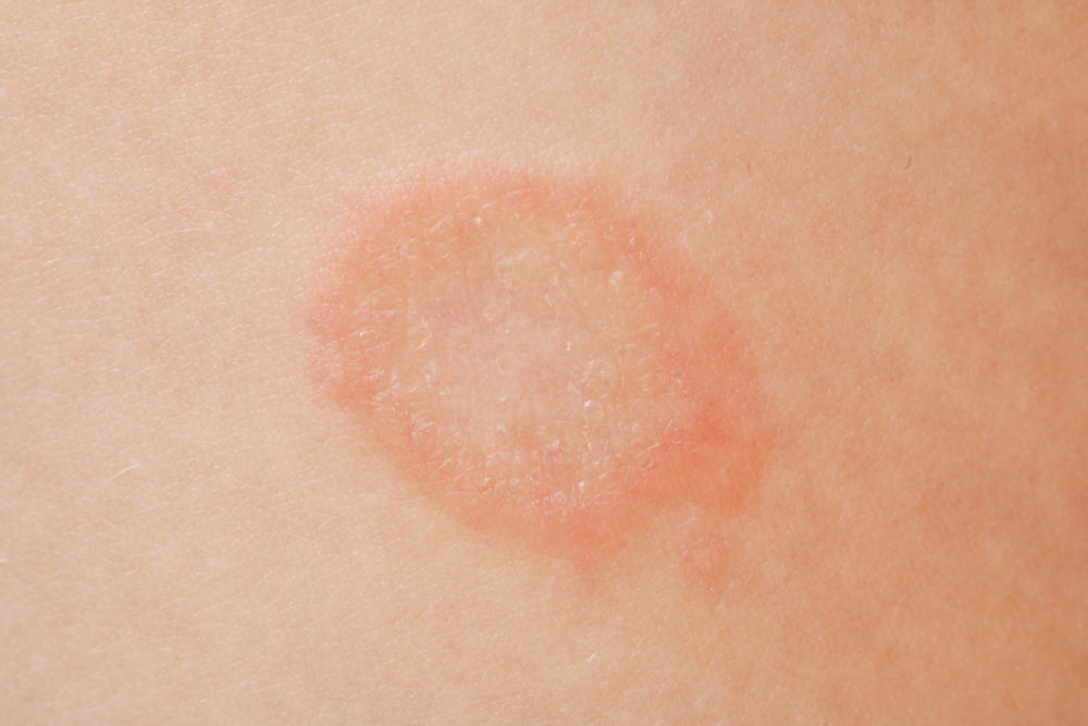 Is That Rash Psoriasis? Psoriasis Pictures and More