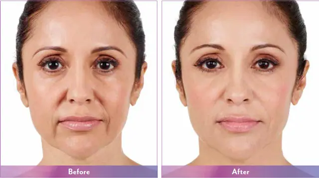 Juvederm Vollure Before After Photo #1