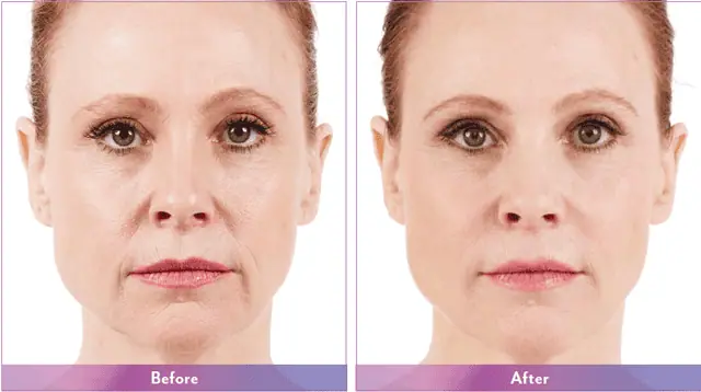 Juvederm Vollure Before After Photo #2