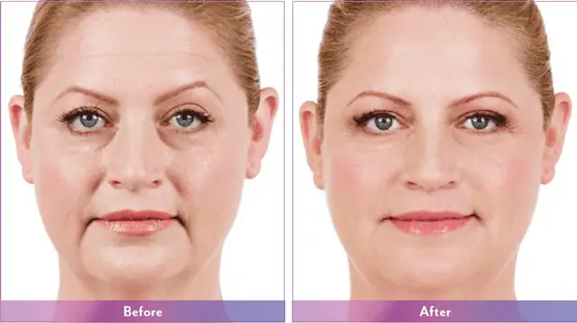 Juvederm Vollure Before After Photo #3